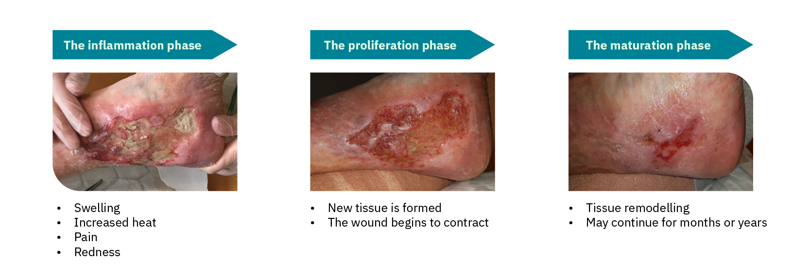 Leg ulcer treatment Symptoms, causes and the healing process