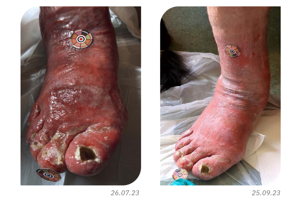 Clinical Outcomes in the Management of Toe Lymphorrhoea with a Superabsorbent Dressing