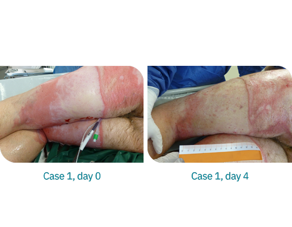 Case1-Burn-injury-treated-with-a-superabsorbent-dressing